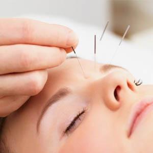 acupuncture